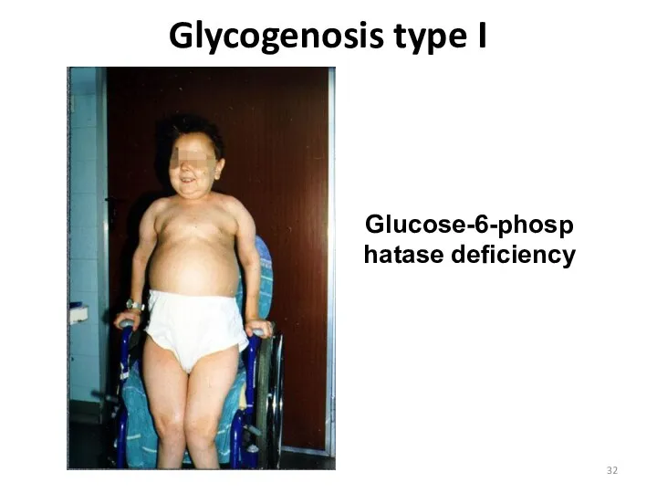 Glycogenosis type I Glucose-6-phosphatase deficiency