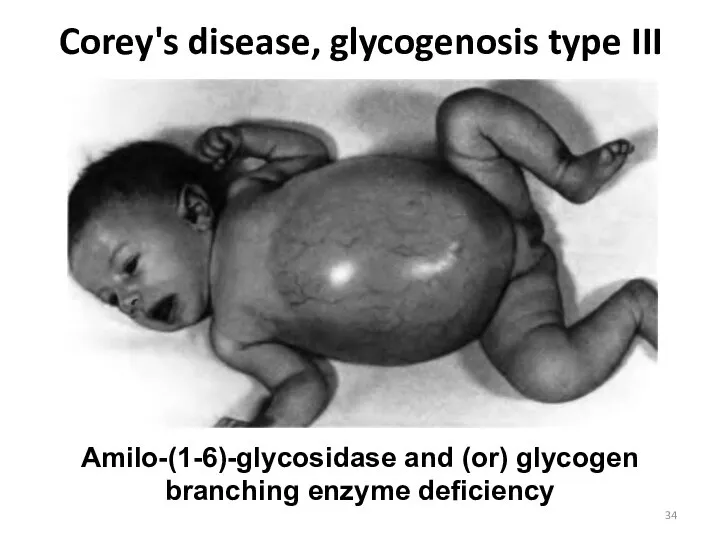 Corey's disease, glycogenosis type III Amilo-(1-6)-glycosidase and (or) glycogen branching enzyme deficiency