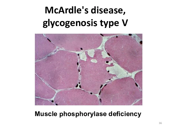McArdle's disease, glycogenosis type V Muscle phosphorylase deficiency