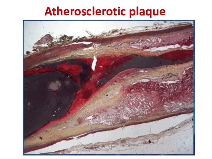 Atherosclerotic plaque