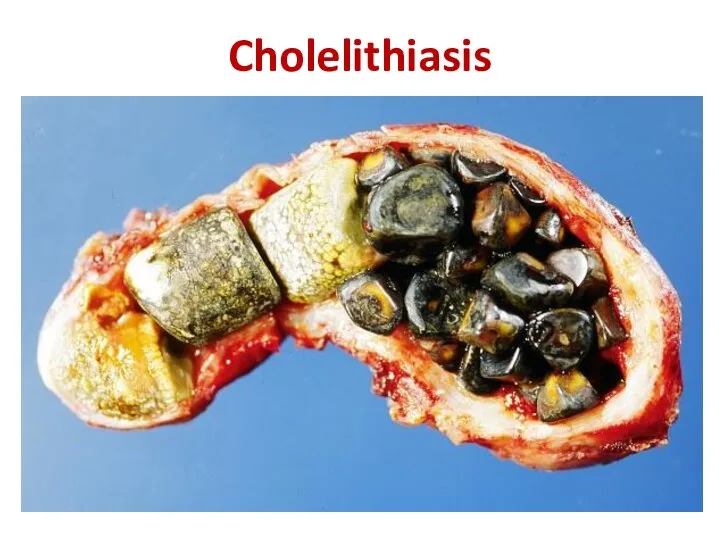 Cholelithiasis