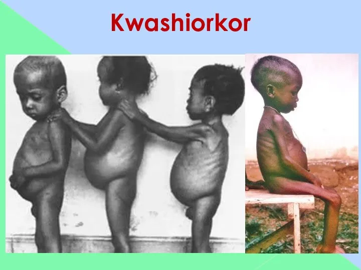 Kwashiorkor