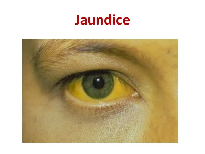 Jaundice