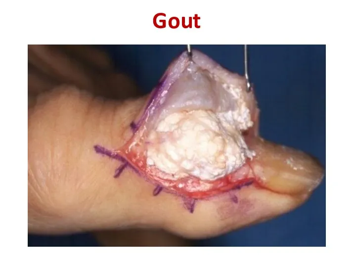 Gout