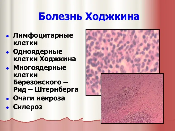 Болезнь Ходжкина Лимфоцитарные клетки Одноядерные клетки Ходжкина Многоядерные клетки Березовского –