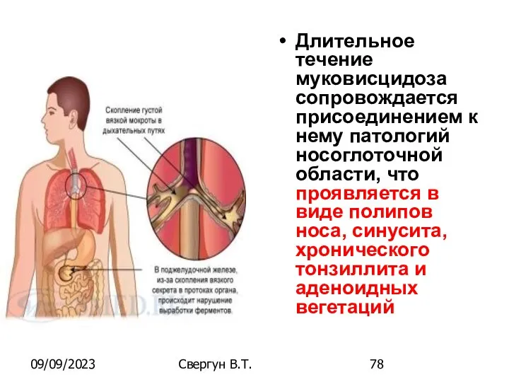 09/09/2023 Свергун В.Т. Длительное течение муковисцидоза сопровождается присоединением к нему патологий