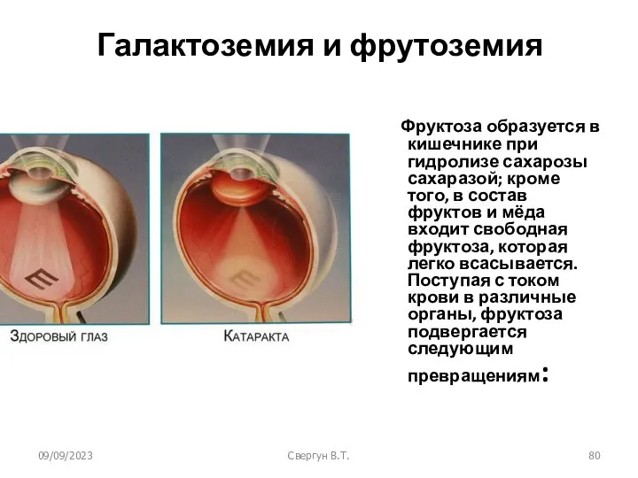 09/09/2023 Свергун В.Т. Галактоземия и фрутоземия Фруктоза образуется в кишечнике при