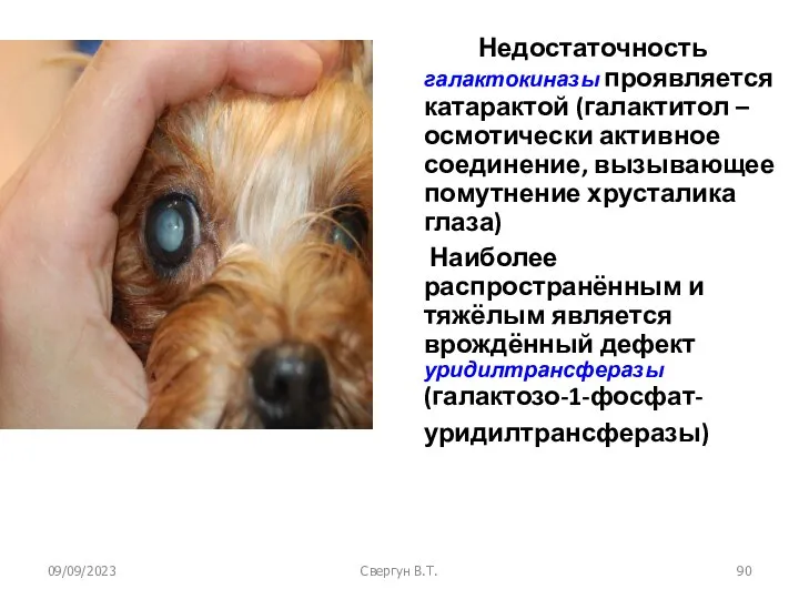 09/09/2023 Свергун В.Т. Недостаточность галактокиназы проявляется катарактой (галактитол – осмотически активное