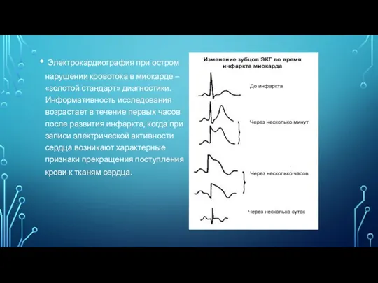 Электрокардиография при остром нарушении кровотока в миокарде – «золотой стандарт» диагностики.