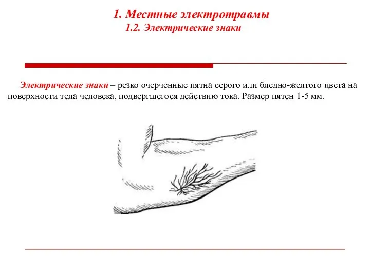 1. Местные электротравмы 1.2. Электрические знаки Электрические знаки – резко очерченные