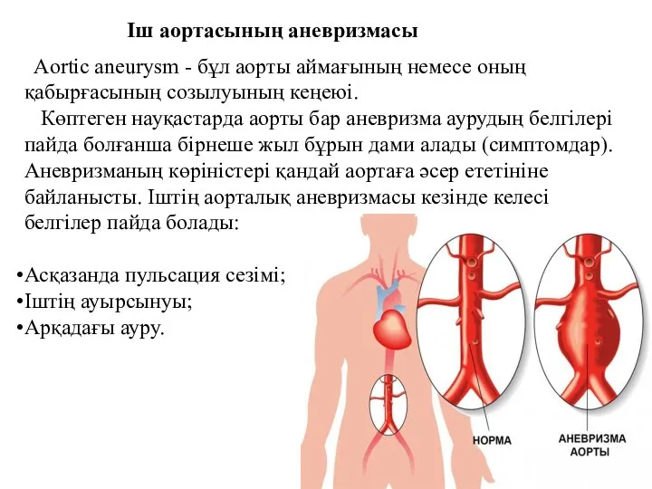 Aortic aneurysm - бұл аорты аймағының немесе оның қабырғасының созылуының кеңеюі.