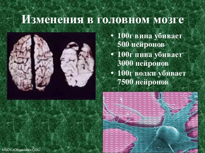 Изменения в головном мозге 100г вина убивает 500 нейронов 100г пива