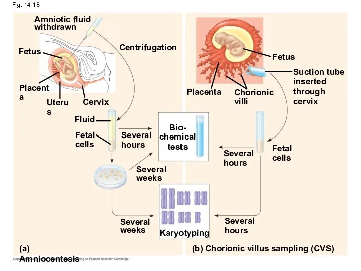 Fig. 14-18 Amniotic fluid withdrawn Fetus Placenta Uterus Cervix Centrifugation Fluid