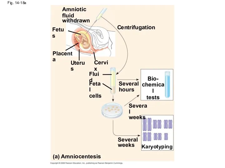 Fig. 14-18a Fetus Amniotic fluid withdrawn Placenta Uterus Cervix Centrifugation Fluid