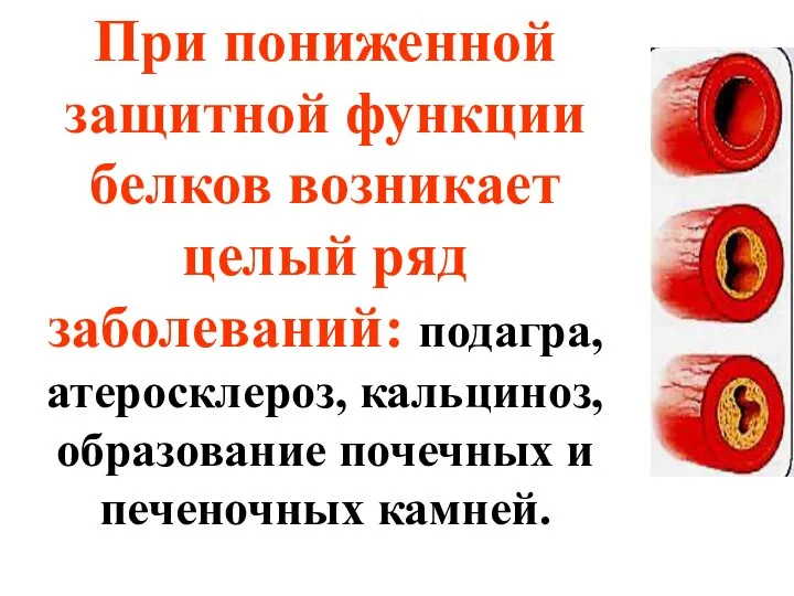 При пониженной защитной функции белков возникает целый ряд заболеваний: подагра, атеросклероз,