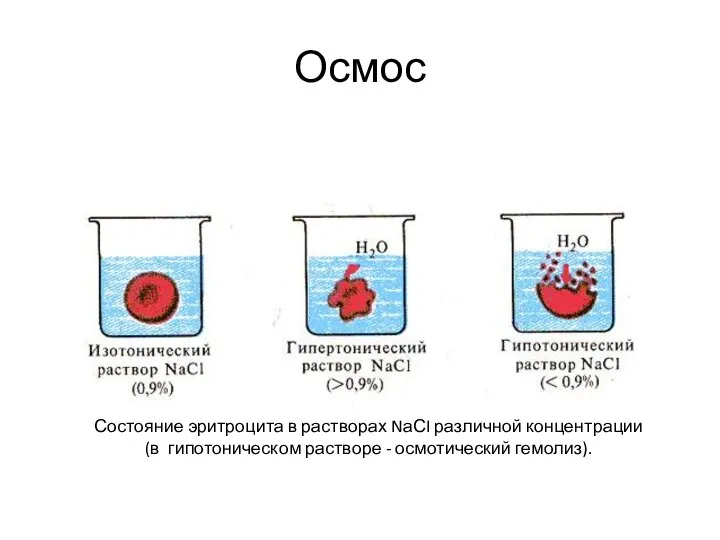 Осмос Состояние эритроцита в растворах NаСI различной концентрации (в гипотоническом растворе - осмотический гемолиз).