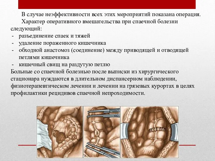 В случае неэффективности всех этих мероприятий показана операция. Характер оперативного вмешательства