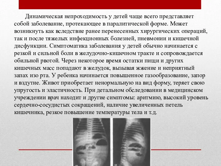 Динамическая непроходимость у детей чаще всего представляет собой заболевание, протекающее в