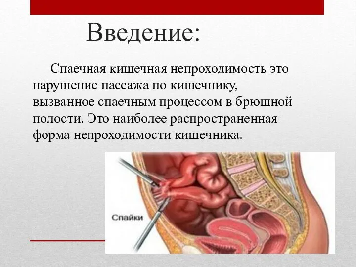 Введение: Спаечная кишечная непроходимость это нарушение пассажа по кишечнику, вызванное спаечным