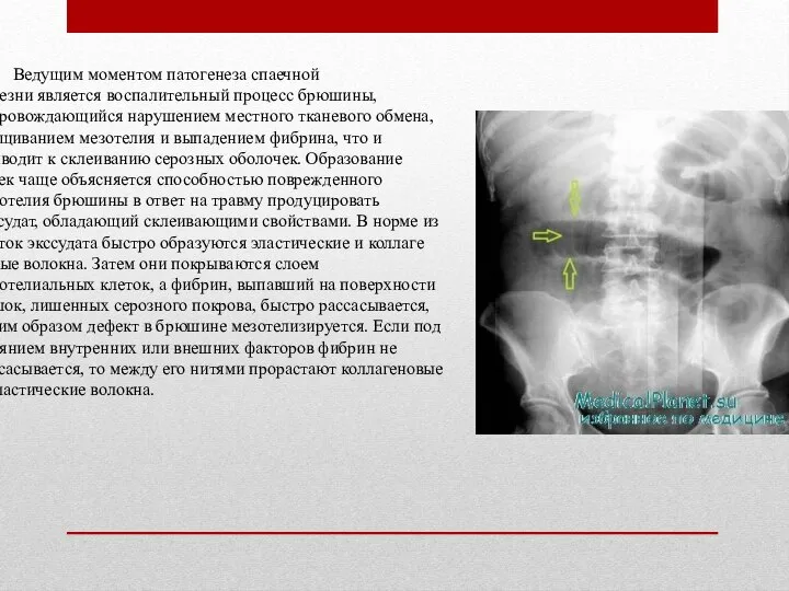 Ведущим моментом патогенеза спаечной болезни является воспалительный процесс брюшины, сопровождающийся наруше­нием