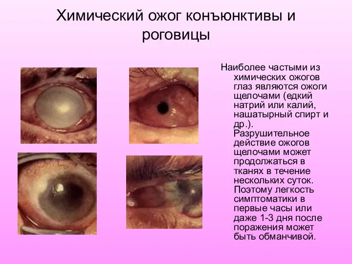 Химический ожог конъюнктивы и роговицы Наиболее частыми из химических ожогов глаз