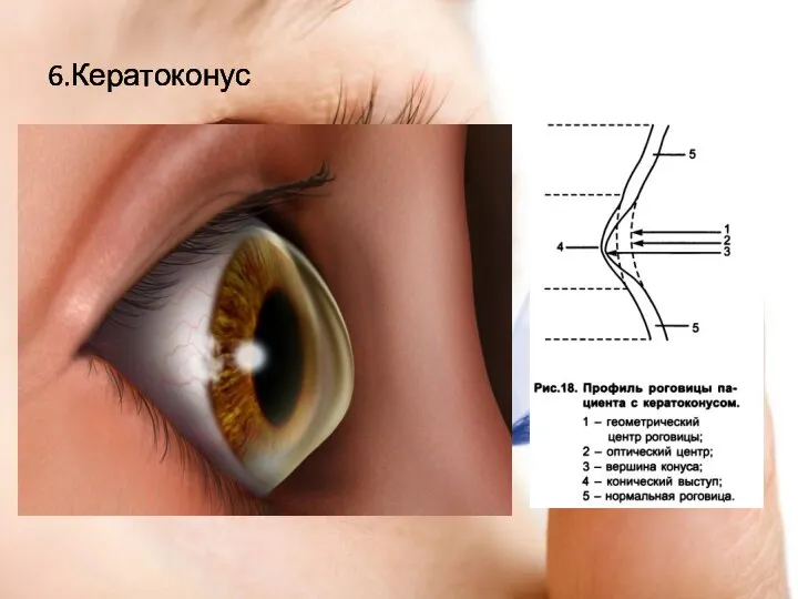 6.Кератоконус