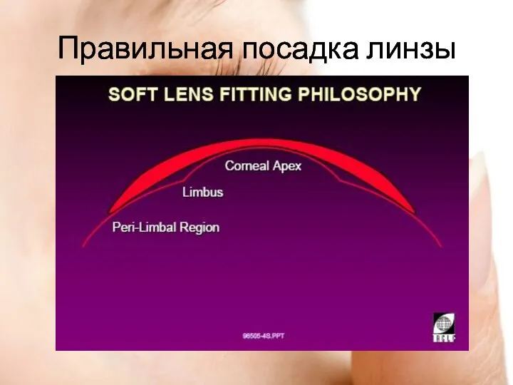 Правильная посадка линзы