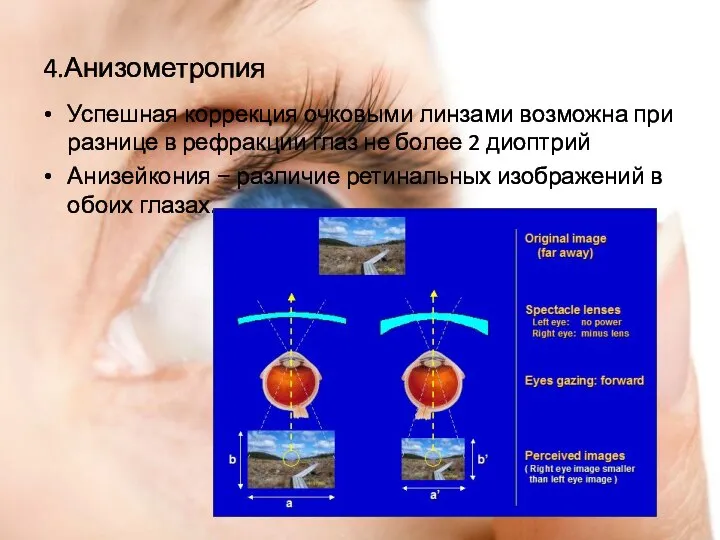 4.Анизометропия Успешная коррекция очковыми линзами возможна при разнице в рефракции глаз