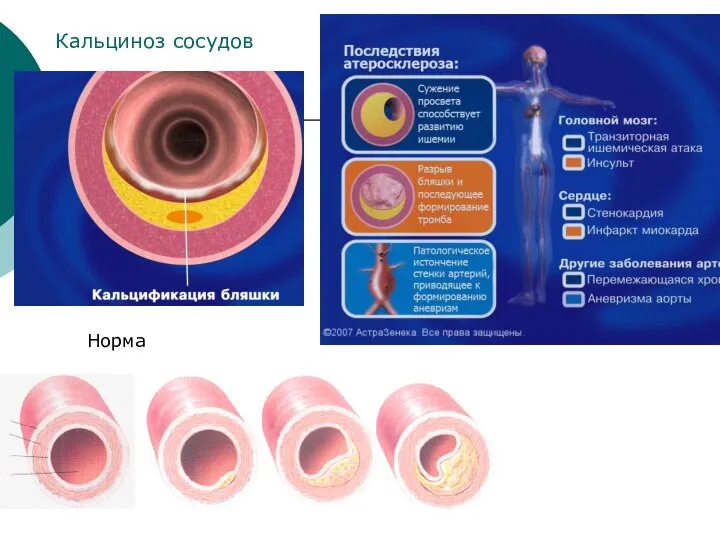 Норма Кальциноз сосудов