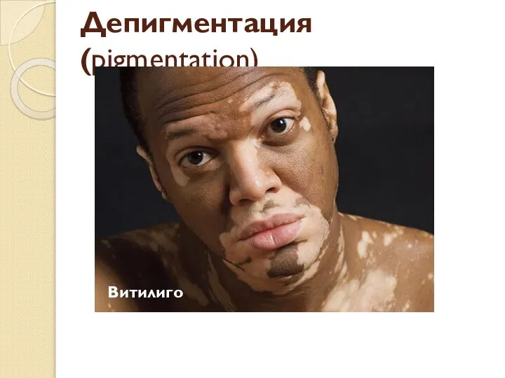 Депигментация(pigmentation) Витилиго