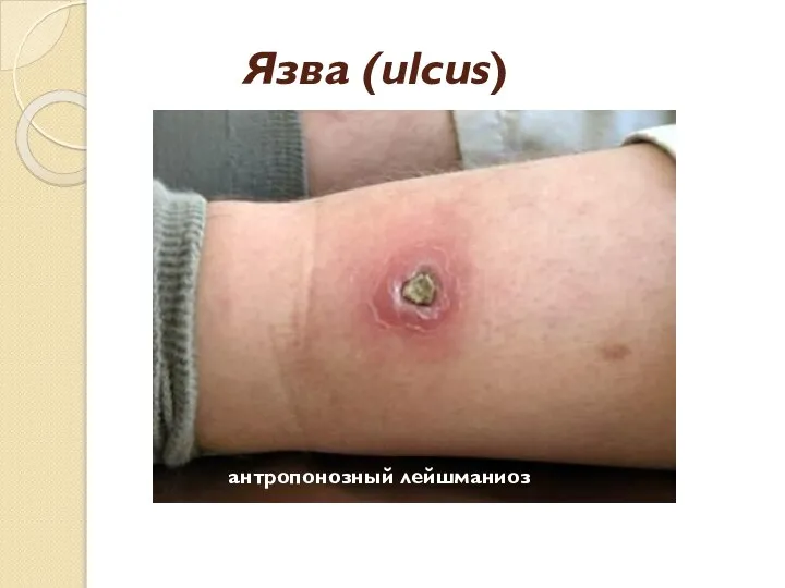 Язва (ulcus) антропонозный лейшманиоз