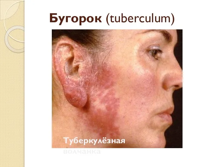 Бугорок (tuberculum) Туберкулёзная волчанка