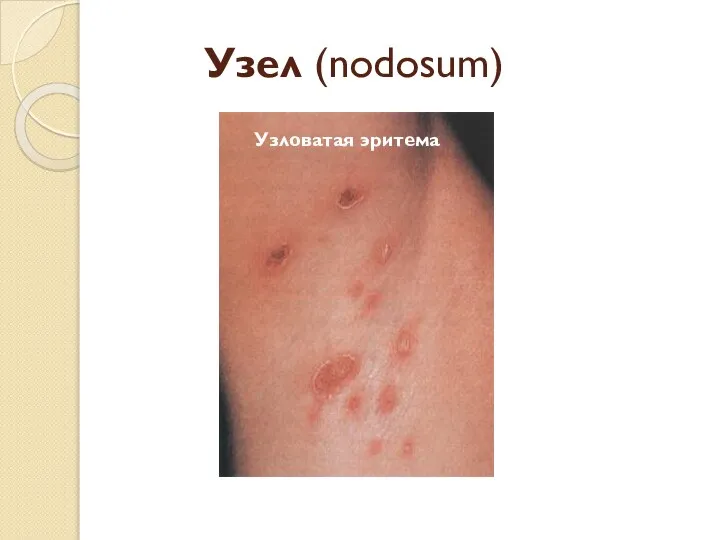 Узел (nodosum) Узловатая эритема