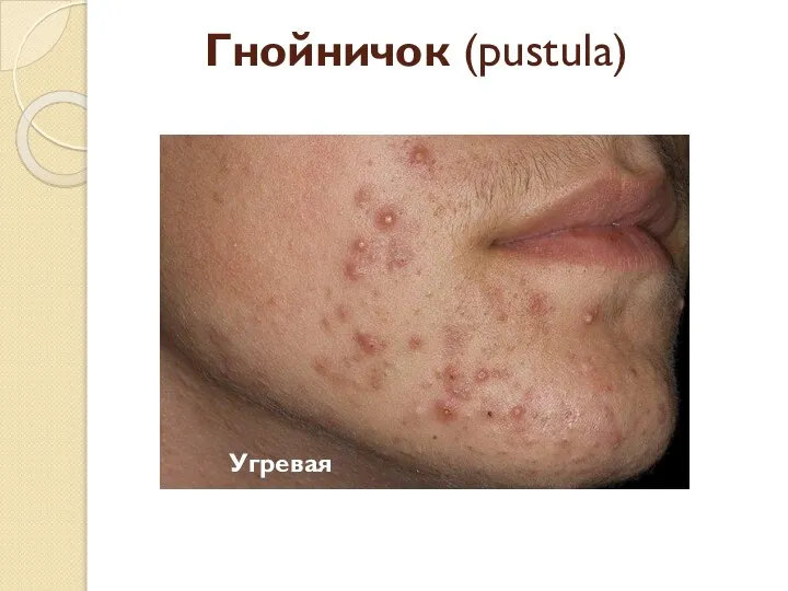 Гнойничок (pustula) Угревая сыпь