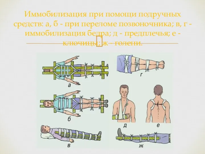 Иммобилизация при помощи подручных средств: а, б - при переломе позвоночника;