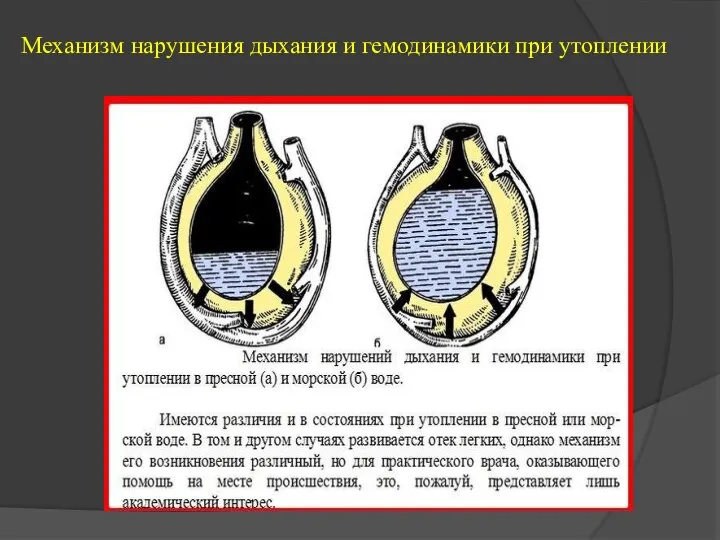 Механизм нарушения дыхания и гемодинамики при утоплении