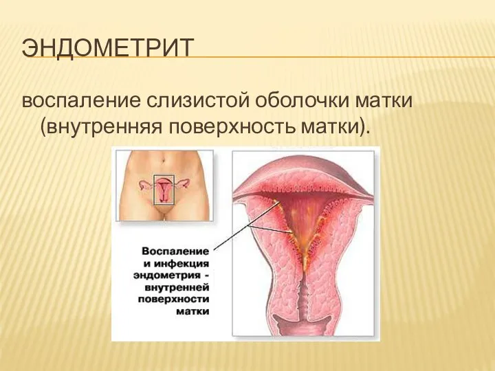 ЭНДОМЕТРИТ воспаление слизистой оболочки матки (внутренняя поверхность матки).