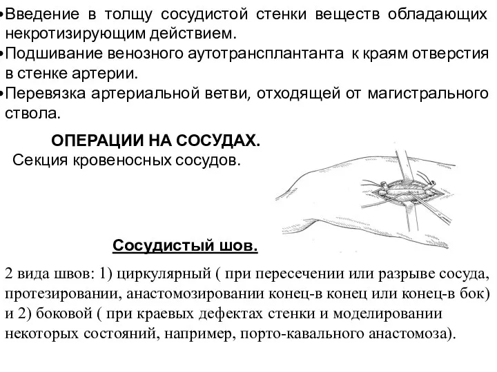 Введение в толщу сосудистой стенки веществ обладающих некротизирующим действием. Подшивание венозного