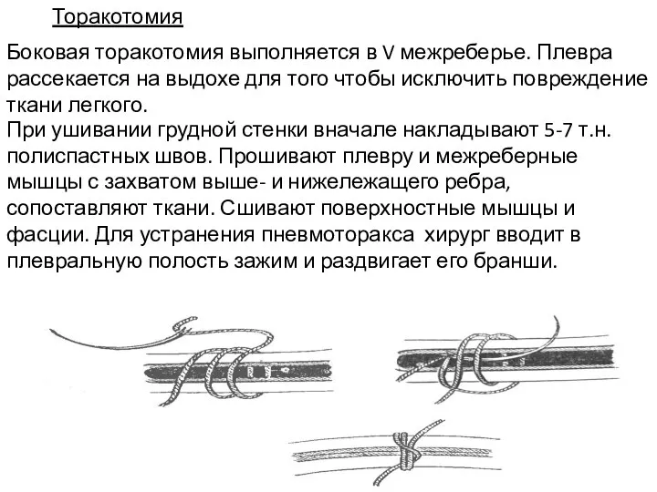 Торакотомия Боковая торакотомия выполняется в V межреберье. Плевра рассекается на выдохе