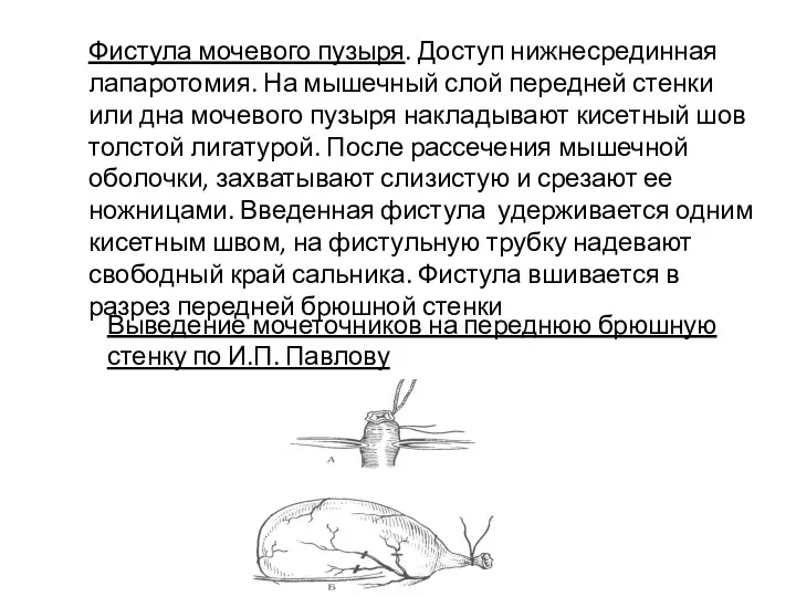 Фистула мочевого пузыря. Доступ нижнесрединная лапаротомия. На мышечный слой передней стенки