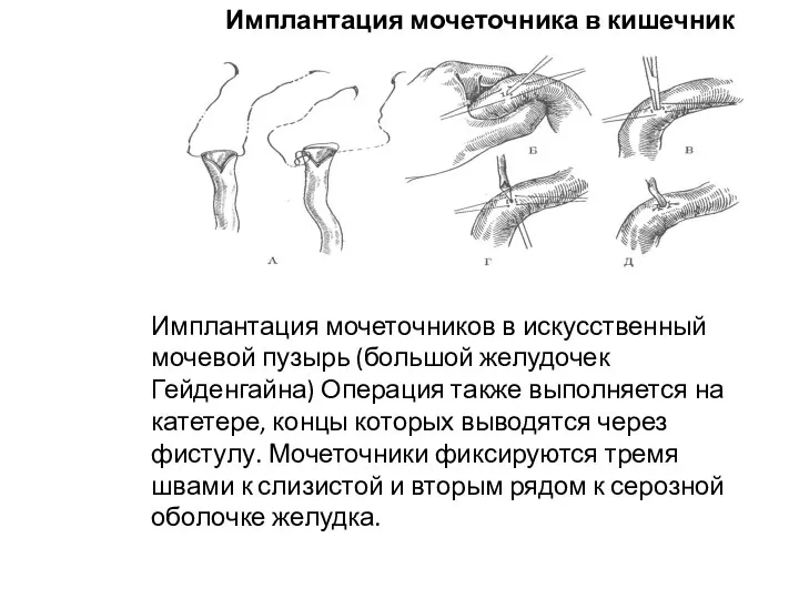 Имплантация мочеточника в кишечник Имплантация мочеточников в искусственный мочевой пузырь (большой