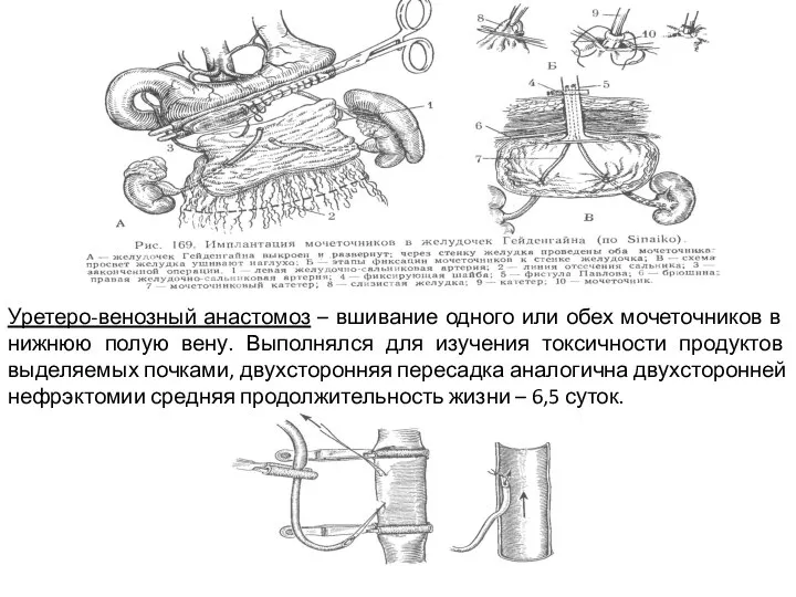 Уретеро-венозный анастомоз – вшивание одного или обех мочеточников в нижнюю полую