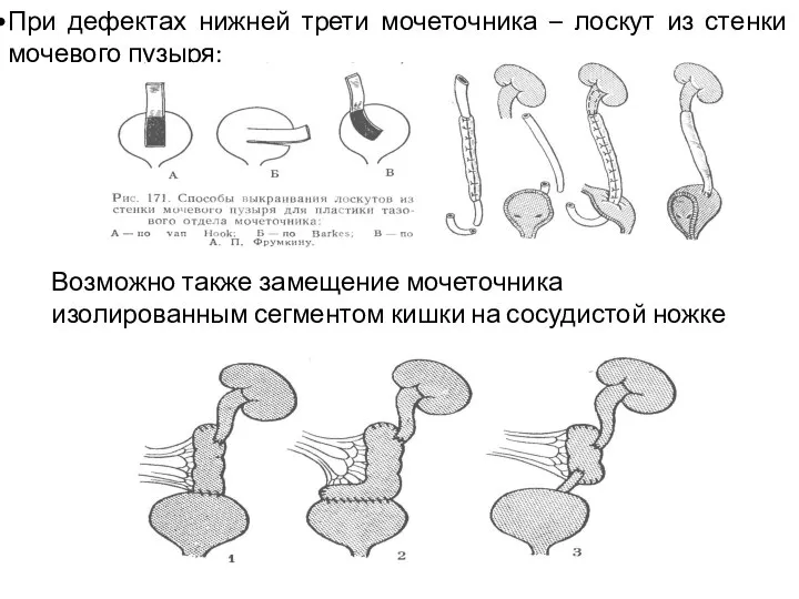 При дефектах нижней трети мочеточника – лоскут из стенки мочевого пузыря;