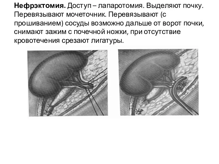 Нефрэктомия. Доступ – лапаротомия. Выделяют почку. Перевязывают мочеточник. Перевязывают (с прошиванием)