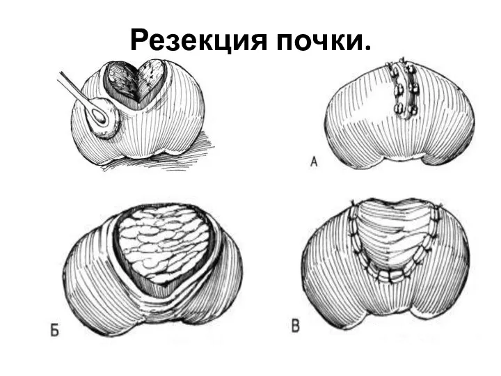 Резекция почки.