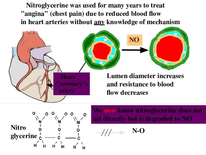 Nitroglycerine was used for many years to treat "angina" (chest pain)