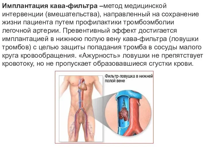 Имплантация кава-фильтра –метод медицинской интервенции (вмешательства), направленный на сохранение жизни пациента