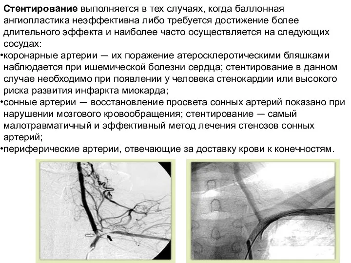 Стентирование выполняется в тех случаях, когда баллонная ангиопластика неэффективна либо требуется