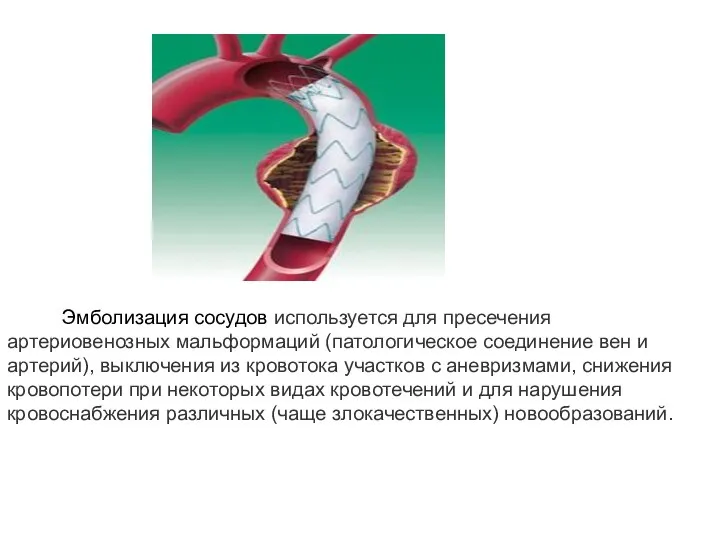 Эмболизация сосудов используется для пресечения артериовенозных мальформаций (патологическое соединение вен и