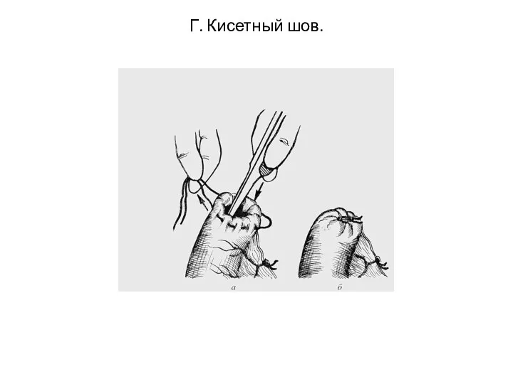 Г. Кисетный шов.